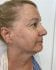 Photofacial 02 - Before Thumbnail 