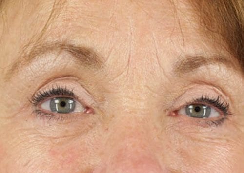 Blepharoplasty Patient 02 - After 