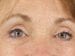Blepharoplasty Patient 02 - After Thumbnail 