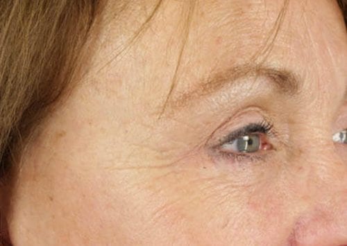 Blepharoplasty Patient 02 - After 