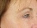 Blepharoplasty Patient 02 - After Thumbnail 