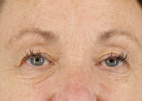 Blepharoplasty Patient 02 - Before 
