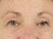 Blepharoplasty Patient 02 - Before Thumbnail 