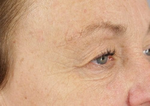 Blepharoplasty Patient 02 - Before 