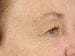 Blepharoplasty Patient 02 - Before Thumbnail 