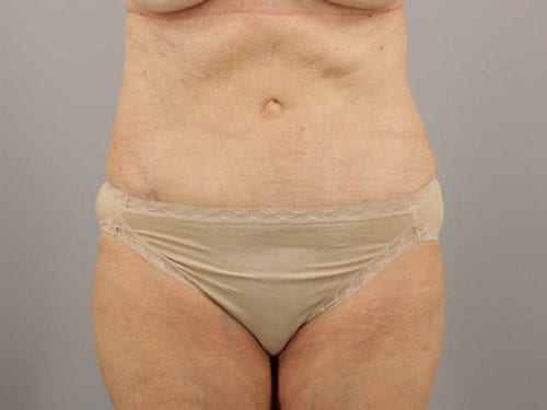 Tummy Tuck Patient 03 - After 