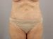 Tummy Tuck Patient 03 - After Thumbnail 