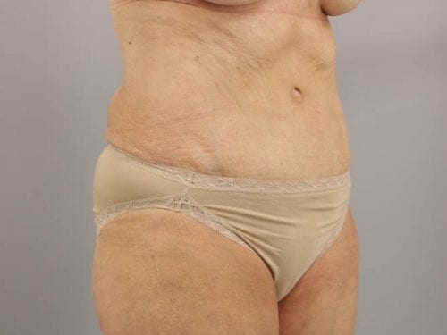 Tummy Tuck Patient 03 - After 