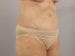 Tummy Tuck Patient 03 - After Thumbnail 