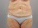 Tummy Tuck Patient 03 - Before Thumbnail 