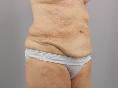 Tummy Tuck Patient 03 - Before 