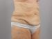 Tummy Tuck Patient 03 - Before Thumbnail 
