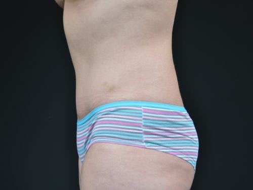Tummy Tuck Patient 05 - After 