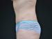 Tummy Tuck Patient 05 - After Thumbnail 