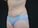 Tummy Tuck Patient 05 - After Thumbnail 