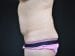 Tummy Tuck Patient 05 - Before Thumbnail 