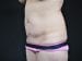 Tummy Tuck Patient 05 - Before Thumbnail 