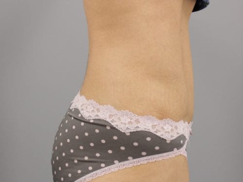 Tummy Tuck Patient 07 - After 