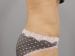 Tummy Tuck Patient 07 - After Thumbnail 