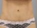 Tummy Tuck Patient 07 - After Thumbnail 