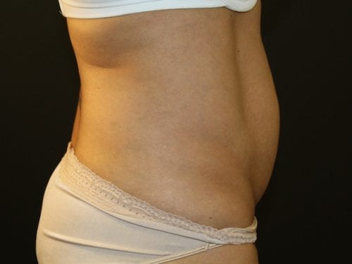Tummy Tuck Patient 07 - Before 