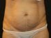 Tummy Tuck Patient 07 - Before Thumbnail 