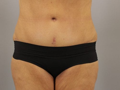 Tummy Tuck Patient 08 - After Thumbnail