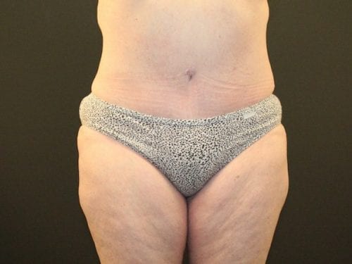 Tummy Tuck Patient 09 - After 