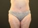 Tummy Tuck Patient 09 - After Thumbnail 