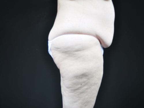 Tummy Tuck Patient 09 - Before 