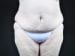 Tummy Tuck Patient 09 - Before Thumbnail 