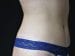 Tummy Tuck Patient 10 - After Thumbnail 