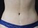 Tummy Tuck Patient 10 - After Thumbnail 