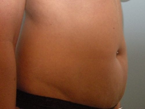 Tummy Tuck Patient 10 - Before 