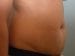 Tummy Tuck Patient 10 - Before Thumbnail 