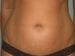 Tummy Tuck Patient 10 - Before Thumbnail 