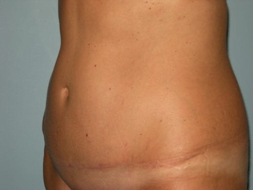 Tummy Tuck Patient 11 - After Thumbnail