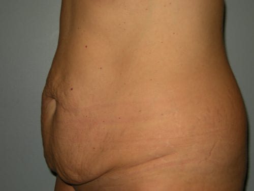 Tummy Tuck Patient 11 - Before Thumbnail