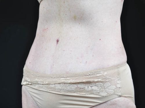 Tummy Tuck Patient 13 - After Thumbnail