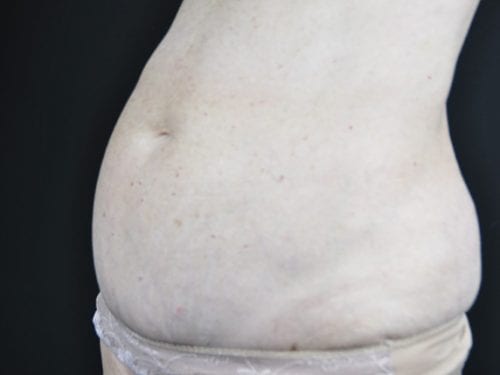 Tummy Tuck Patient 13 - Before Thumbnail