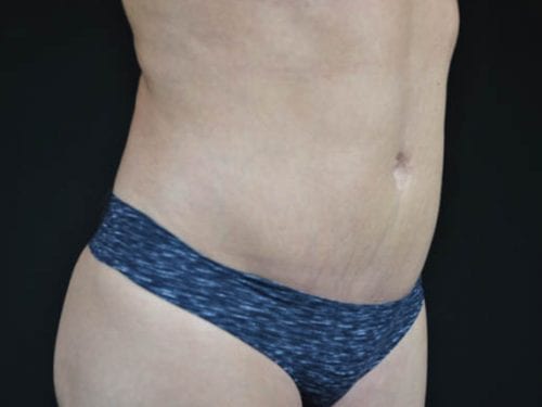 Tummy Tuck Patient 15 - After Thumbnail