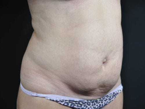 Tummy Tuck Patient 15 - Before Thumbnail