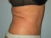 Tummy Tuck Patient 16 - After Thumbnail 