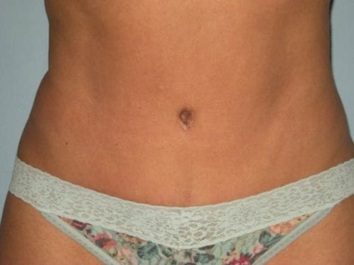 Tummy Tuck Patient 16 - After 
