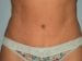 Tummy Tuck Patient 16 - After Thumbnail 
