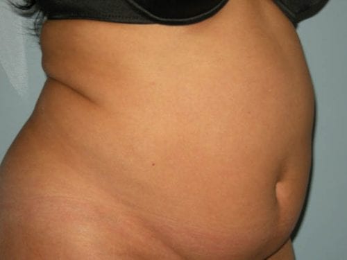 Tummy Tuck Patient 16 - Before 