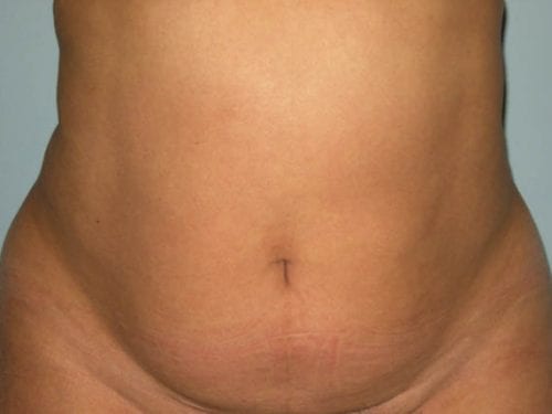 Tummy Tuck Patient 16 - Before 