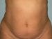 Tummy Tuck Patient 16 - Before Thumbnail 