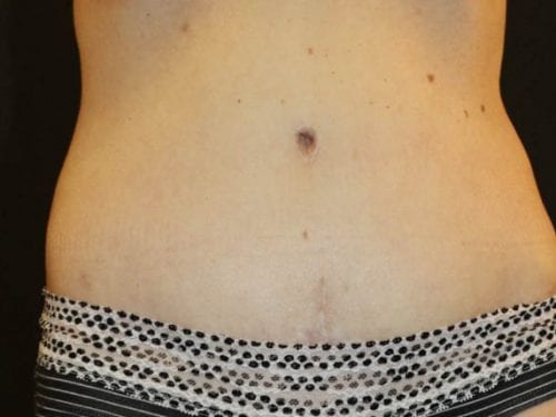 Tummy Tuck Patient 17 - After Thumbnail