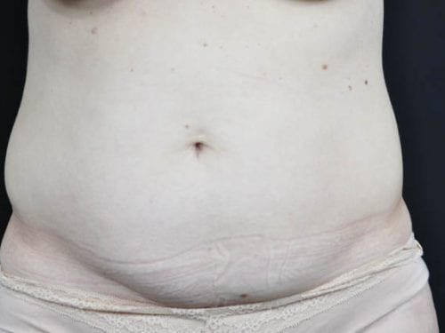 Tummy Tuck Patient 17 - Before Thumbnail